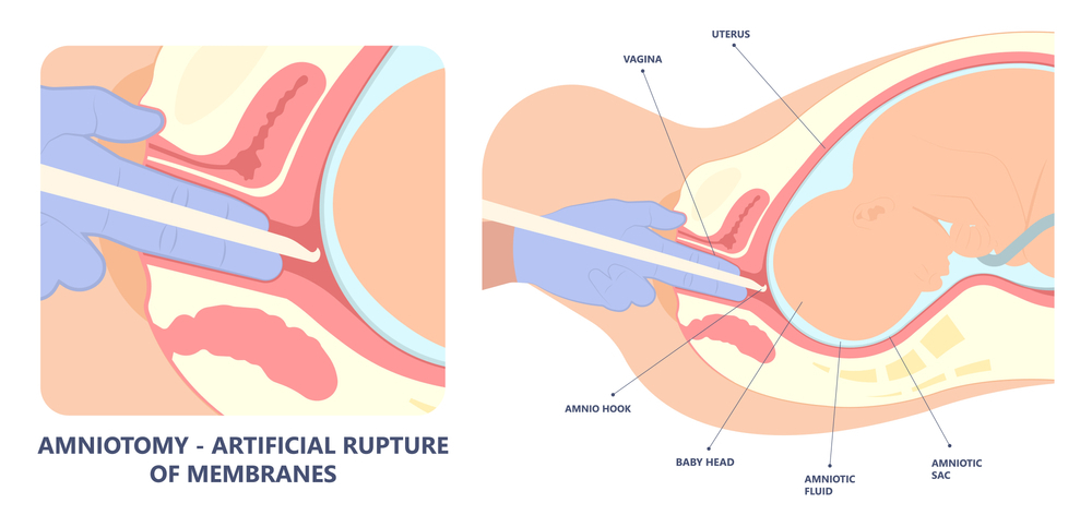 Amniotomy - artificial rupture of membrane