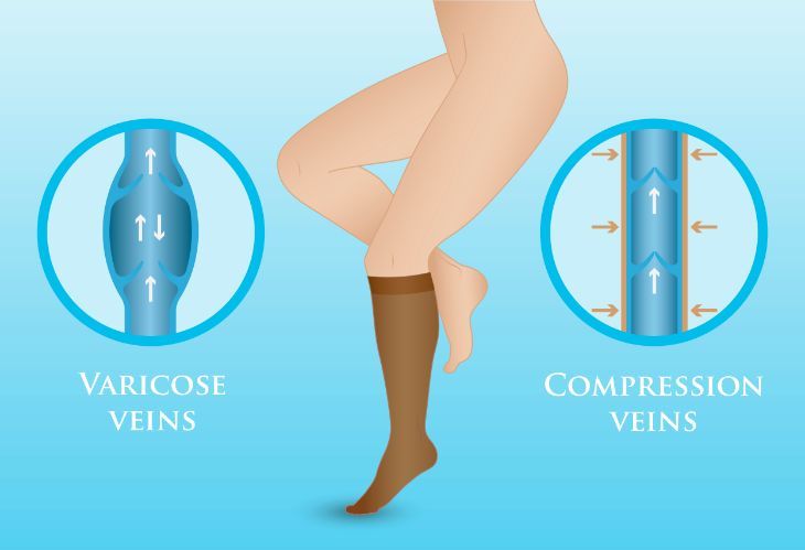 effect of compression stockings in varicose veins