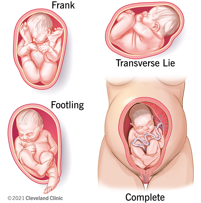 types of breech baby positions