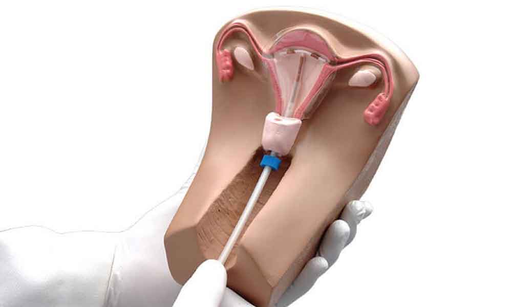 INTRAUTERINE DEVICE