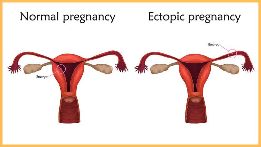 An ectopic pregnancy occurs when a fertilised egg grows outside of the uterus.