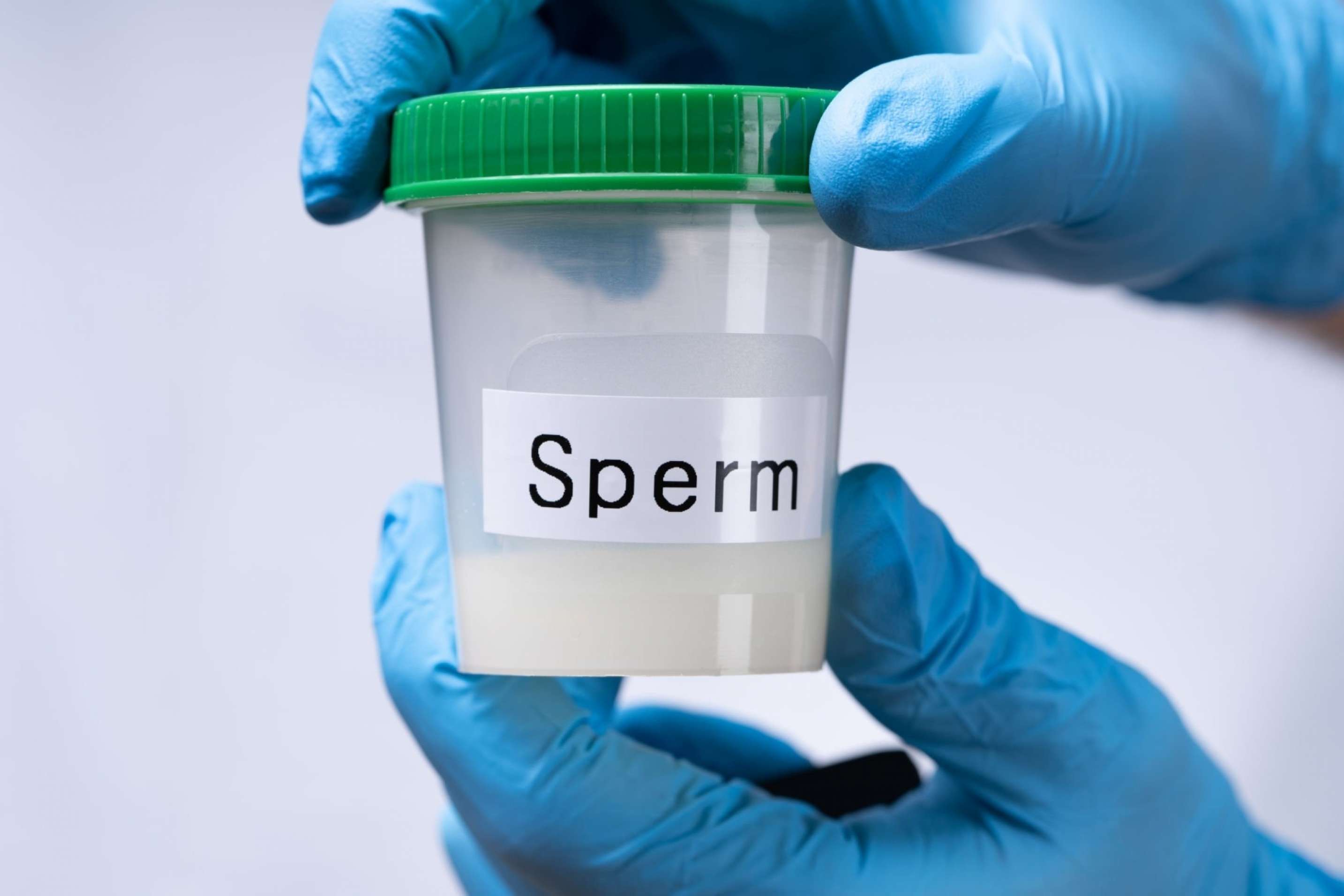 If you need donor sperm to get conceived, IUI may be one of the best options for you, which can be done with the frozen sperm preserved already.