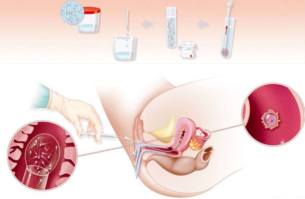 Intrauterine insemination (IUI) is a procedure that involves carefully placing the washed and prepared sperm directly into your uterus and not in the ovaries, unlike IVF, during your prime fertile days.