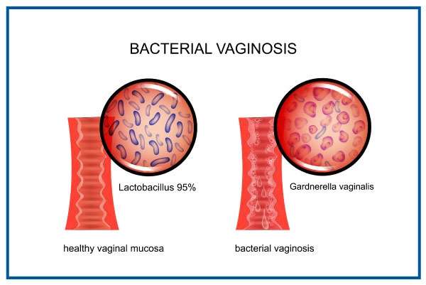 What is Bacterial Vaginosis (BV)?