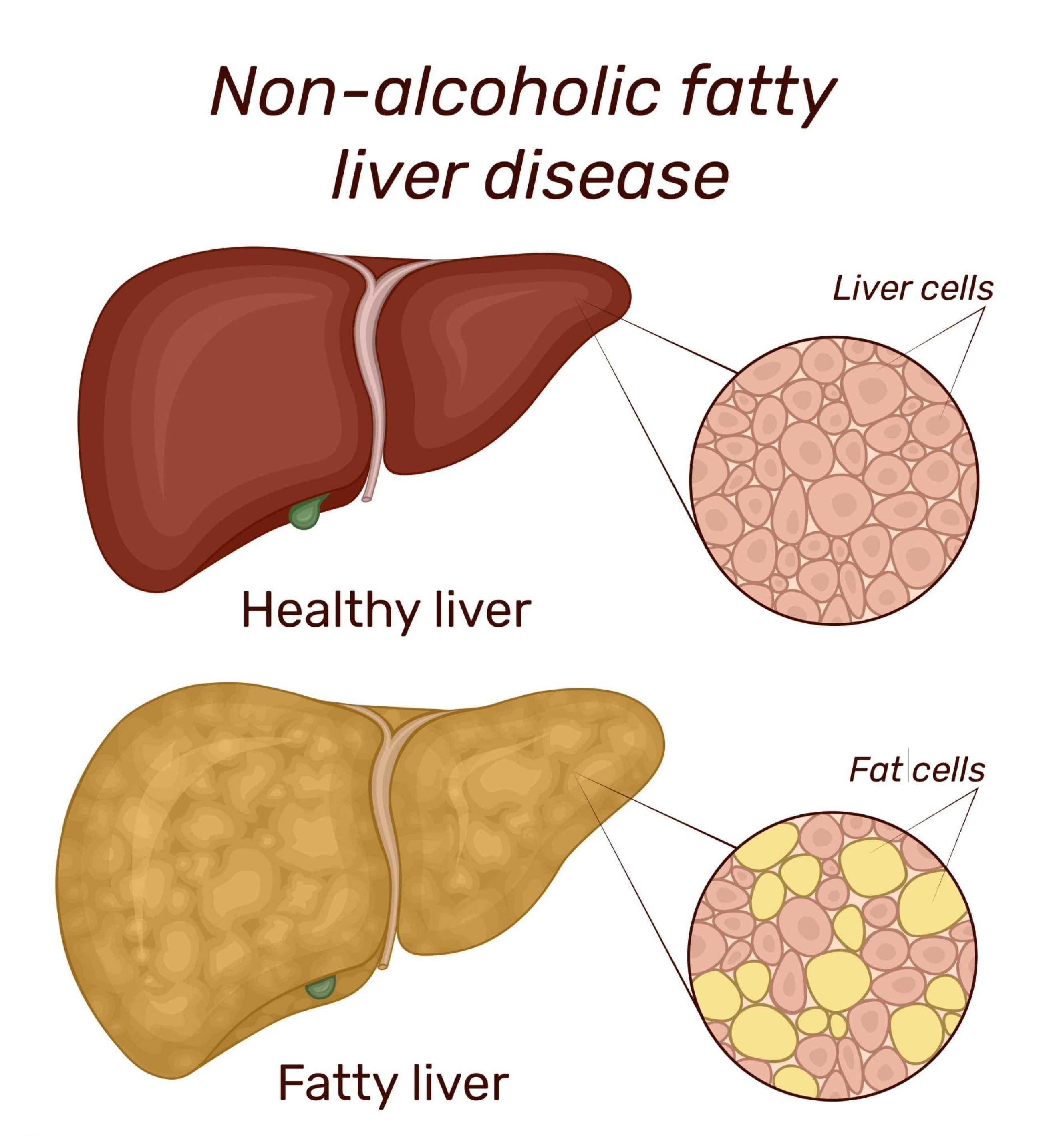 Non-alcoholic fatty liver and Normal channel