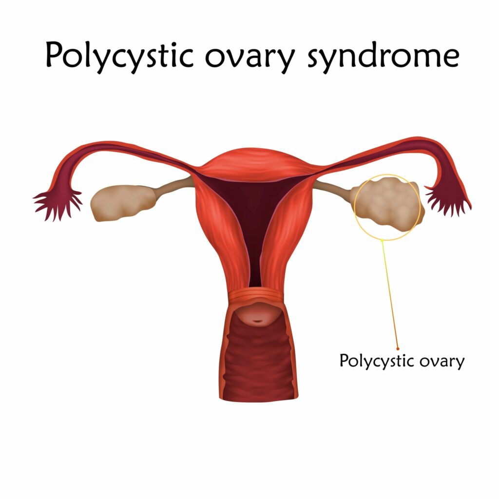 How PCOS affects fertility?